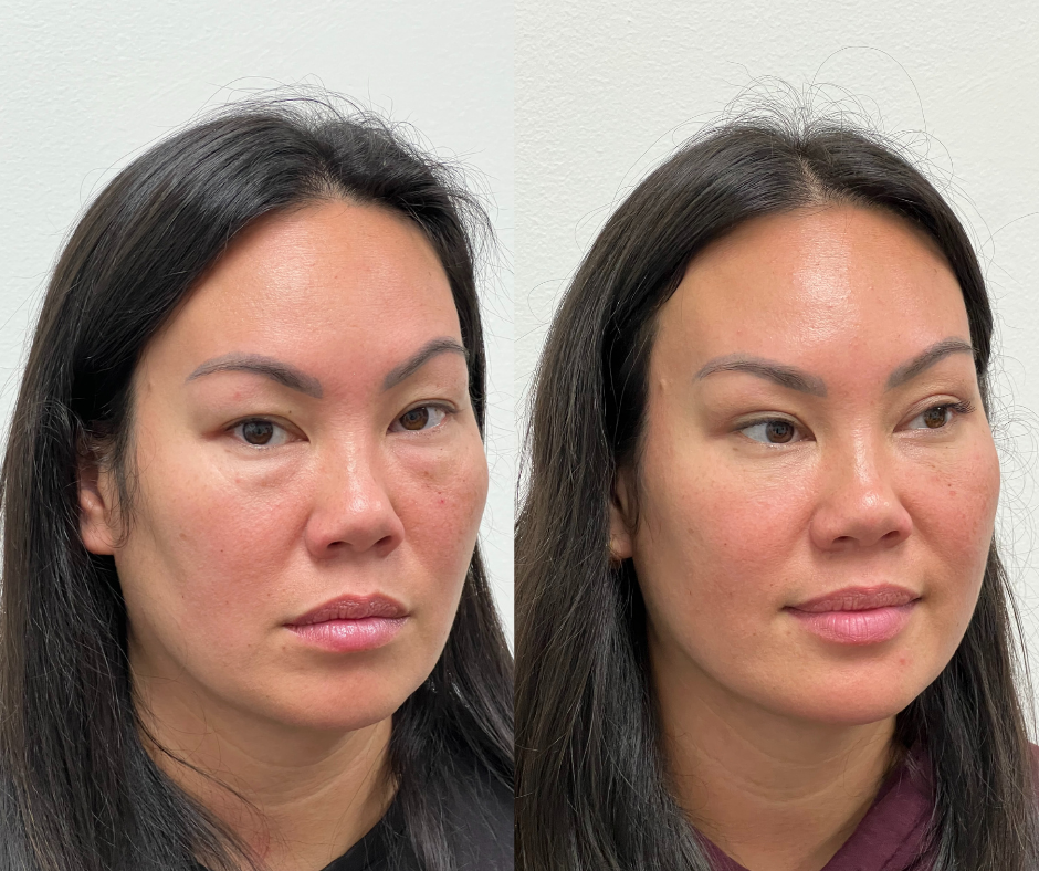 Upper Blepharoplasty