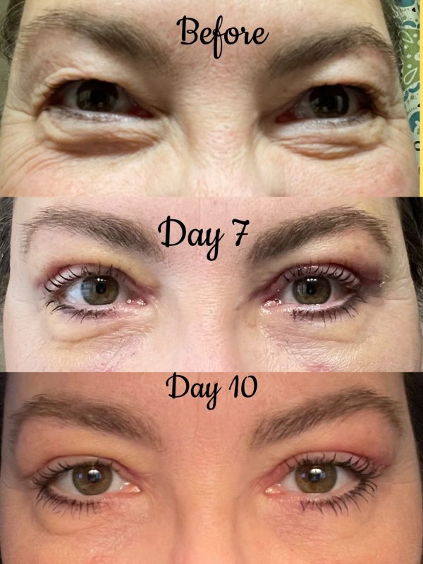 Bilateral upper and lower eyelid blepharoplasty 1
