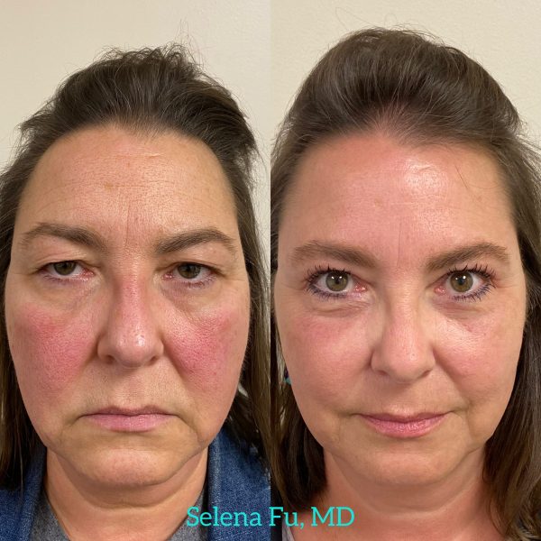 Bilateral upper and lower eyelid blepharoplasty 2a