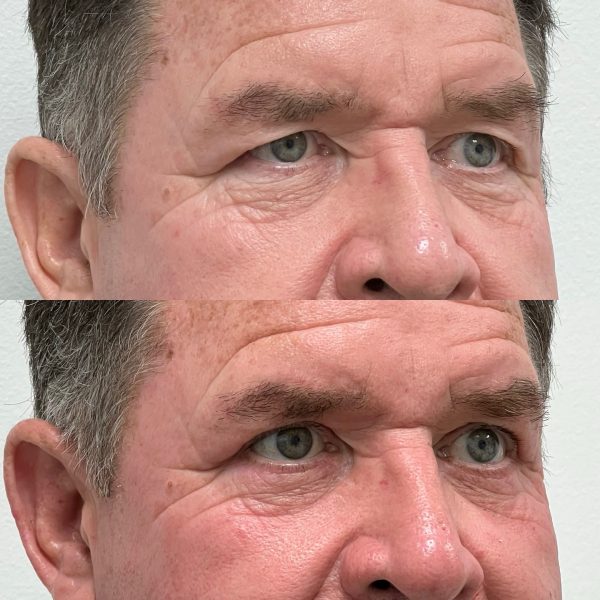 Bilateral upper and lower eyelid blepharoplasty 6