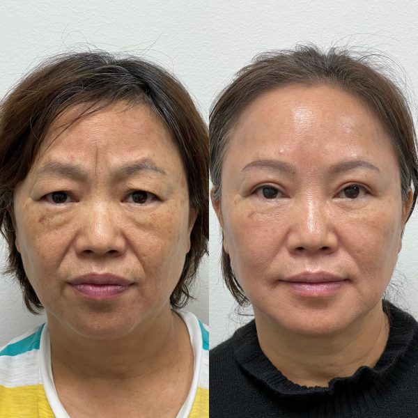 Bilateral upper and lower eyelid blepharoplasty 8