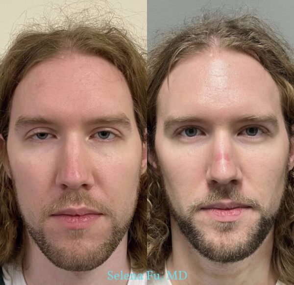 Bilateral upper eyelid ptosis repair 2