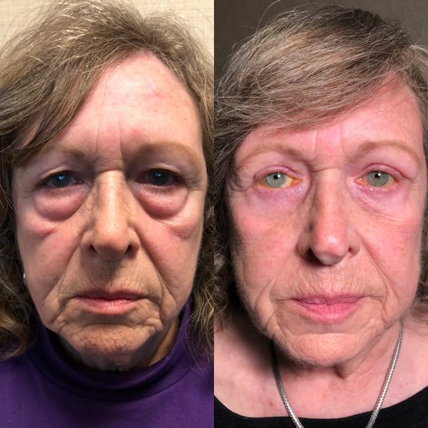 Upper and Lower Lid Blepharoplasty